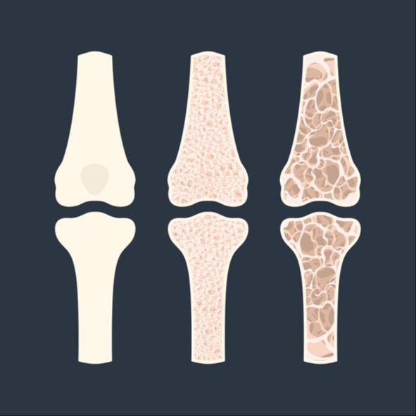 osteoporosi